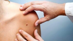 Лечение бородавок во сне