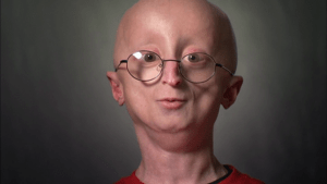 Детская прогерия - генетическая мутация Детская прогерия - генетическая болезнь